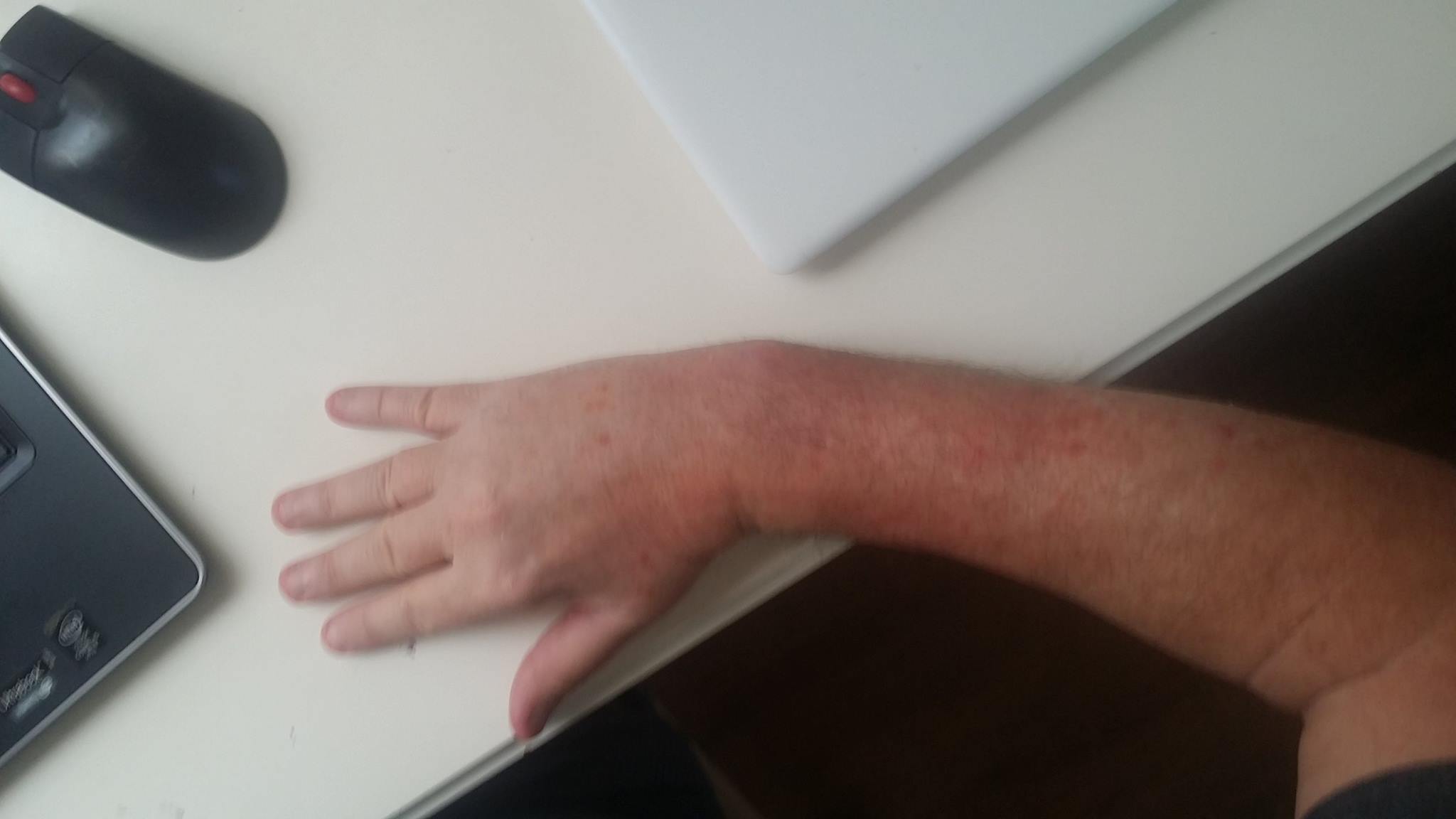 Cast off broken wrist USA not good probably surgery