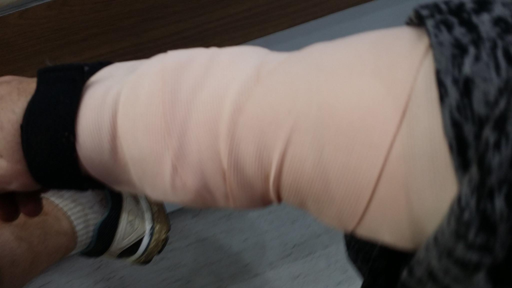 Arm not out of place bumps in shin guard Chiang Mai crash wrist